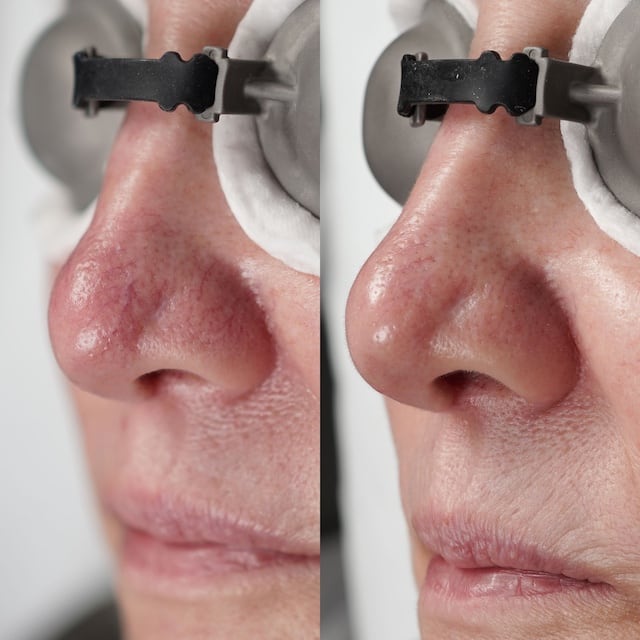 Thread vein and broken capillary clearance on nose, with eye protection.