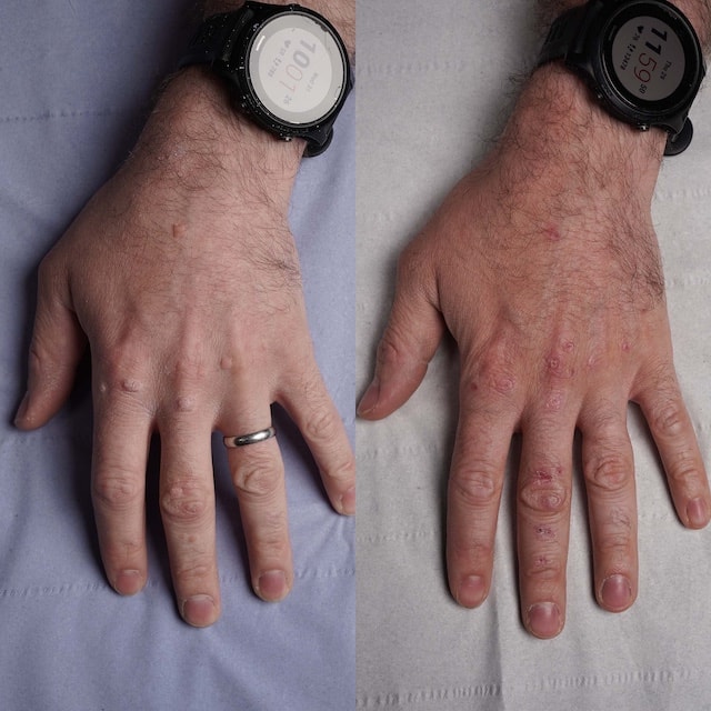 Multiple warts on male hand healing one month after Nd:YAG laser treatment