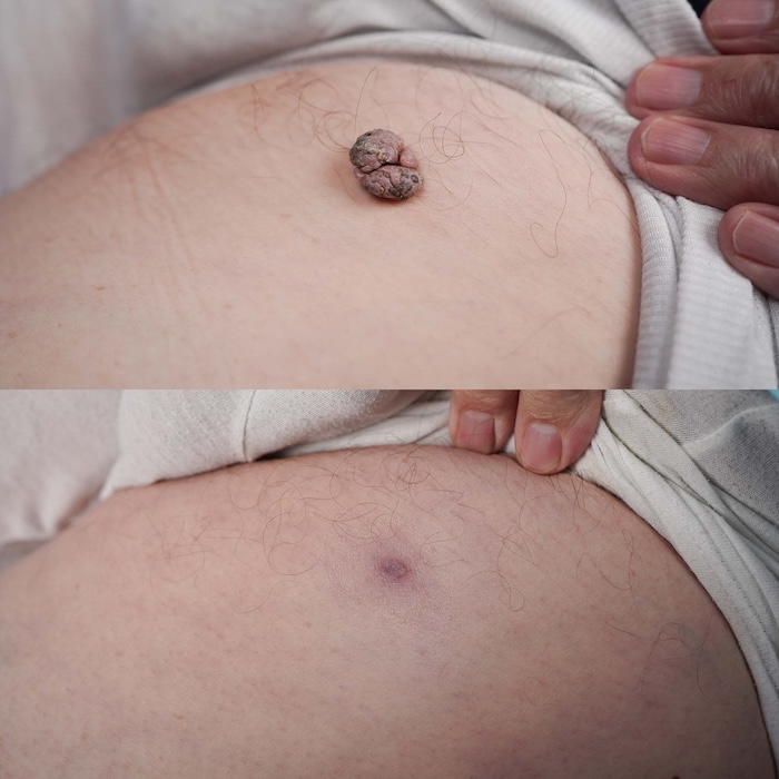 One-month post-treatment photo of skin tag removal site, showing smooth, healed skin