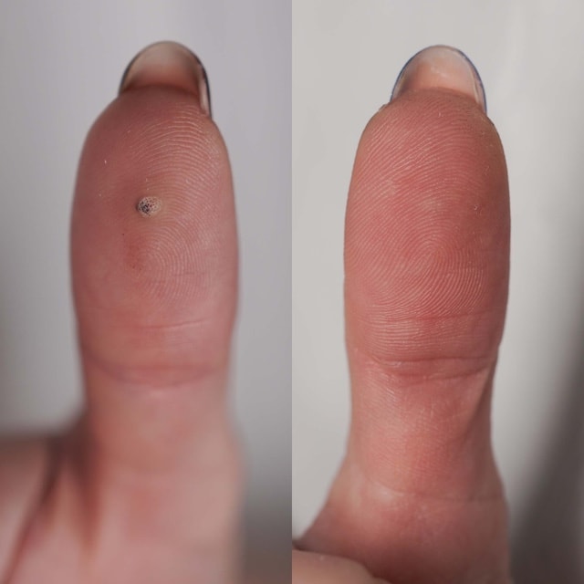 Laser treatment result on fingertip wart, treated alongside a verruca in the same session