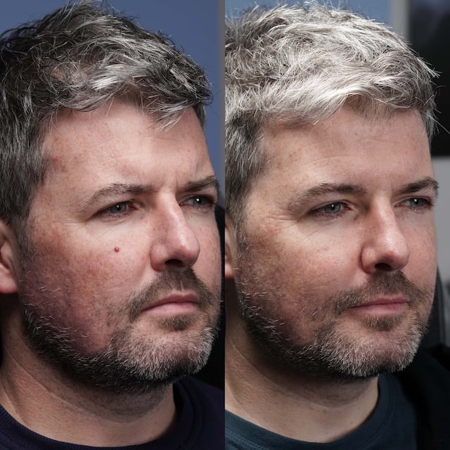 Angiofibroma to cheek removed in 1 treatment