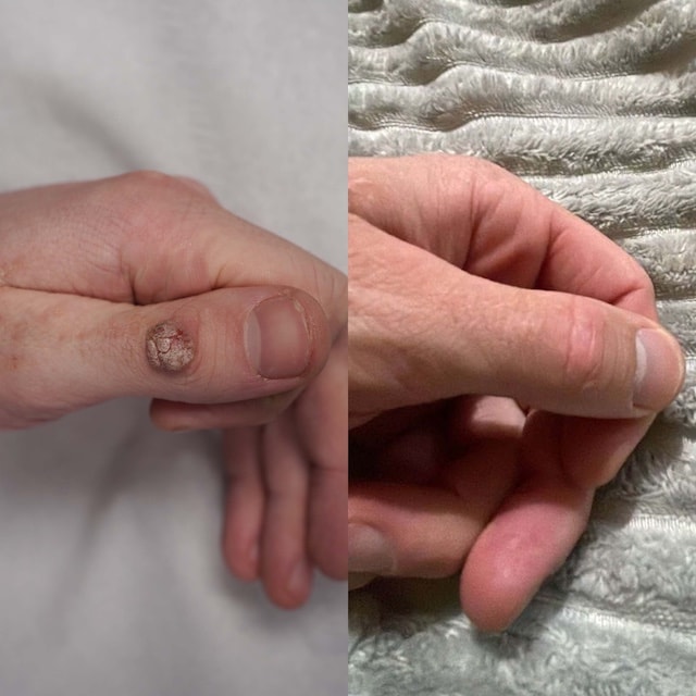 Large wart on thumb cleared in a single laser treatment using long-pulse Nd:YAG