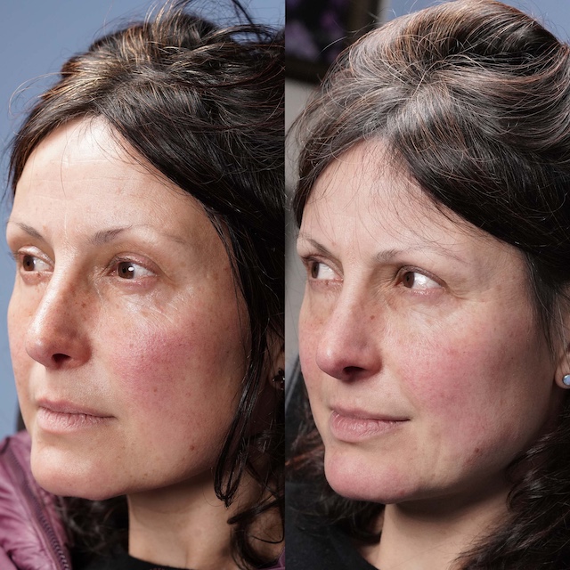 Laser vein removal on a beautiful face