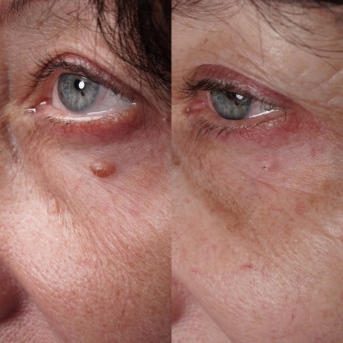 Close-up of the eye area before and after fibroma removal, showing clearance of a raised lesion beneath the lower eyelid.
