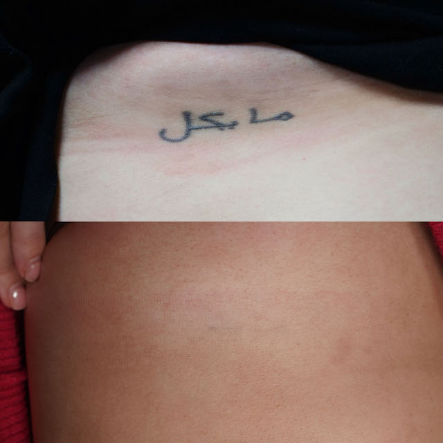 tattoo removal before and after