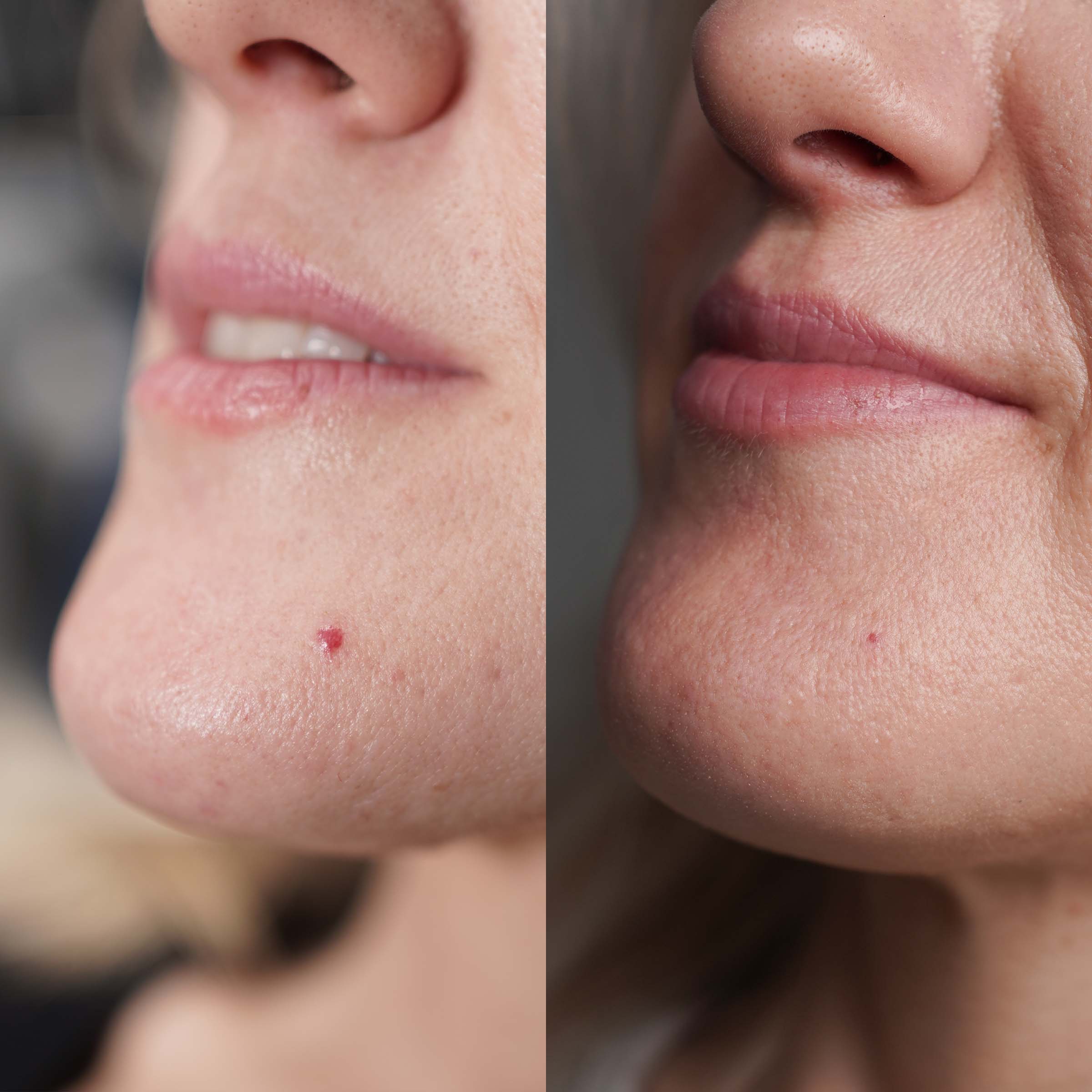 cherry angioma on chin nearly gone after a single treatment