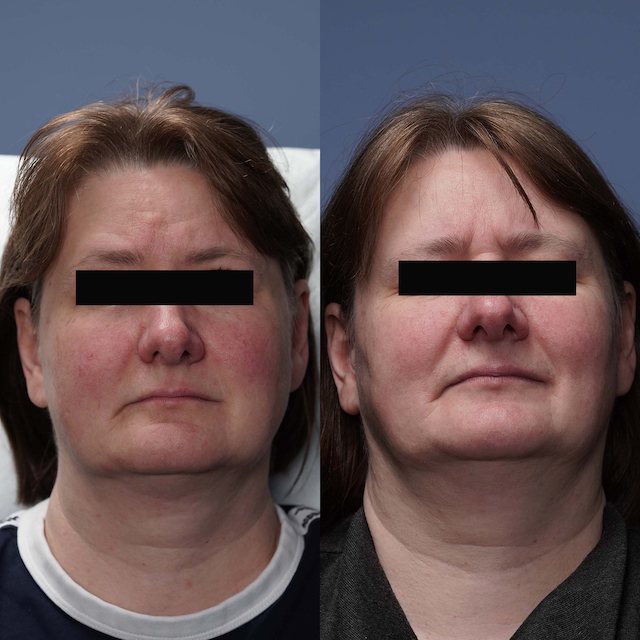 Vein removal before and after