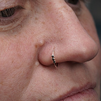 Benign fibroma laser removal on face – no downtime