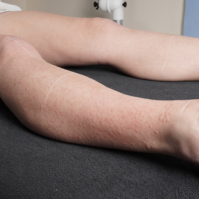 laser facial before and after