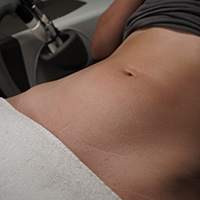 Permanent laser hair removal problem facial hair – Inverness clinic