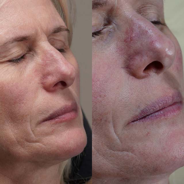 Vein removal before and after