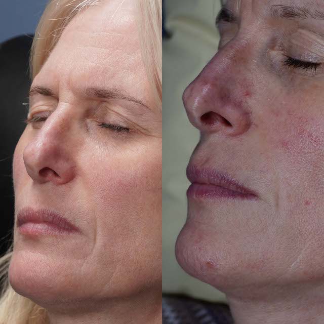 Vein removal before and after