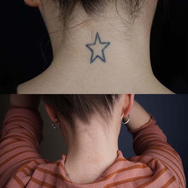 Tattoo removal before and after