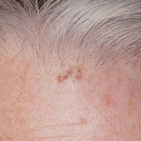 Sun damage, age spot and seborrheic keratosis laser removal – Quanta laser technology