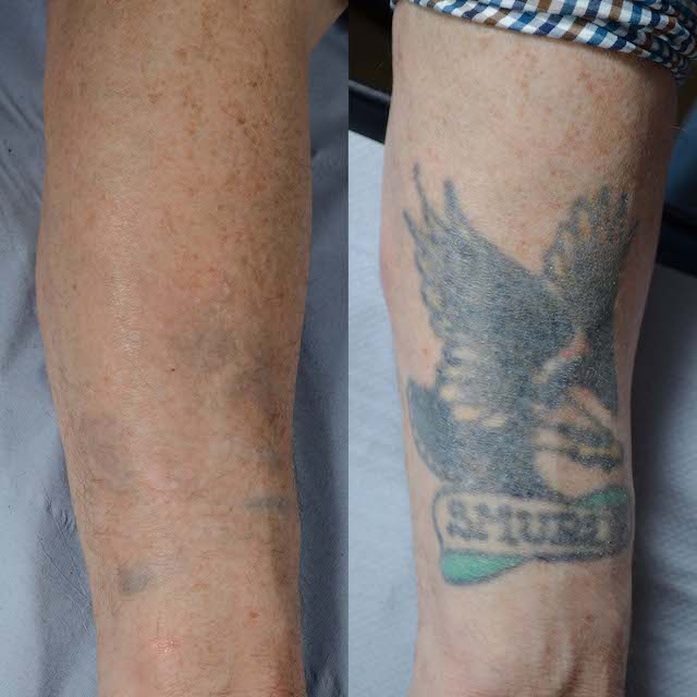 Tattoo removal before and after