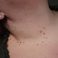 Safe skin tag removal using medical-grade laser