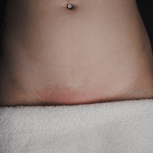 Bikini hair removal after treatment