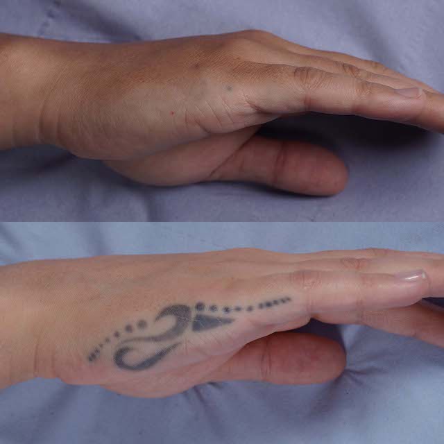 Hand tattoo removal