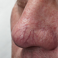 Laser treatment for threadvein, veins, angioma and telangiectasia